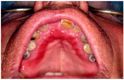 IJERPH | Free Full-Text | Management of Chronic Atrophic Candidiasis (Denture Stomatitis)—A ...