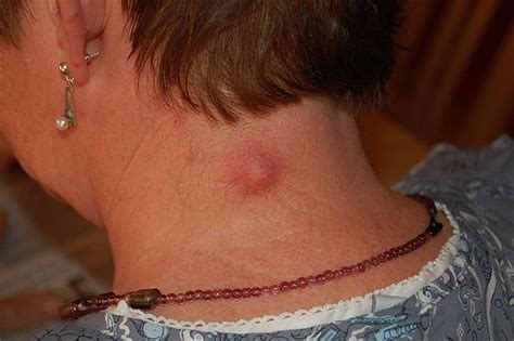 Lumps and Bumps at Back or Side of Neck: Small, Large, Soft, Hard, Painful - eHealthStar