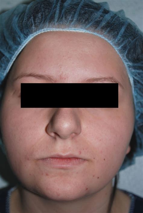 Rhinoplasty, Facial, Appearance, Facial Treatment, Facial Care, Face Care, Face