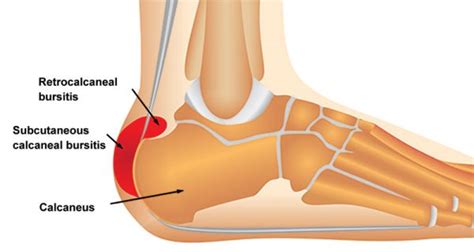 Pain at the back of the heel Archives - Sportsinjuryclinic.net