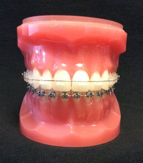 Types of Braces: Ceramic Braces | Charleston Orthodontic Specialists | Dientes con brackets ...