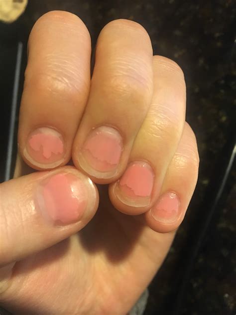 One year of nail bed growth! : r/nailbiting