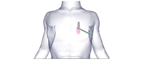 Implantable Loop Recorder - One Heart Cardiology