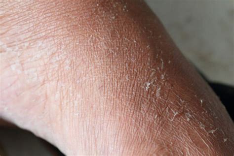 How to Tell if Your Skin Is Dehydrated - Professional Surgical Dermatology Services | Dermatology