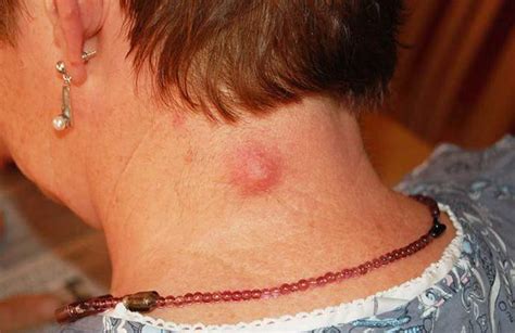 Home Remedies for a Boil on the Neck — Healthy Builderz