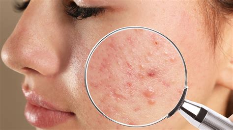 Acne Scars And Dark Spots: What Are They And How Do You Get Rid Of Them?