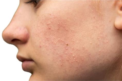 15 Causes Of Bumps On The Face + Best Treatments, From Derms | mindbodygreen