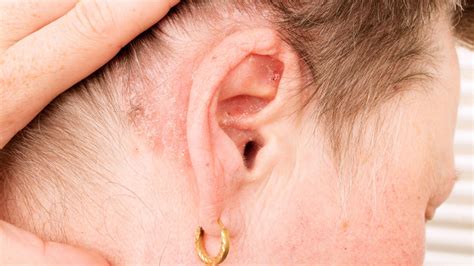 Psoriasis In The Ear: Symptoms, Treatment, and Prevention – Dermeleve®