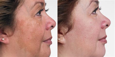 Hormonal Pigmentation/Melasma Treatment at Clínica Privé | Portimão | Algarve