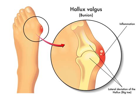 Understanding Bunions: What They Are & What Causes Them - Dr. McHugh ...