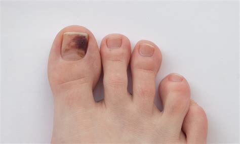 melanoma under toenail pictures | Symptoms and pictures