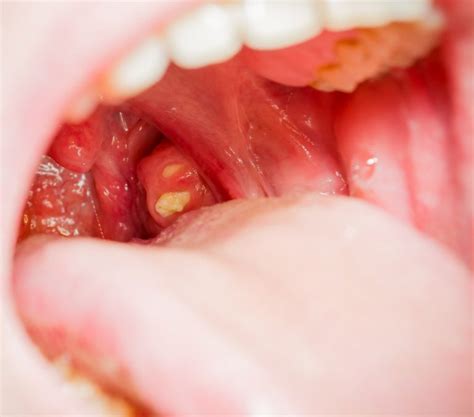 White Spots On Tonsils Symptoms Causes And Treatments Viewhealthy ...