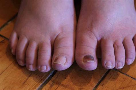 Black Toenail Cancer: Things You Must Know - Nedufy