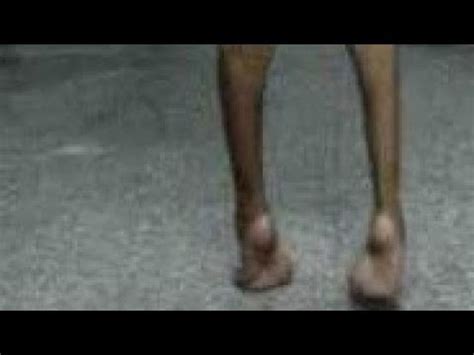 TRUE EQUINUS GAIT I PHYSIO FUNDA I CP SPASTIC DIPLEGIA GAIT SERIES I PART 2 - YouTube