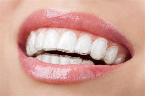 Invisalign vs Traditional Braces | Jennifer Stachel Orthodontics