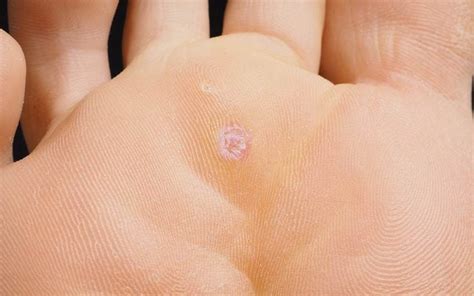 Plantar Wart Removal: How to Remove Warts with Duct Tape | The Healthy