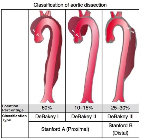 Aneurysm | Aortic dissection, Dissection, Cardiac sonography