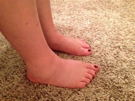 Swollen Ankles: 10 Swollen Ankles Symptoms