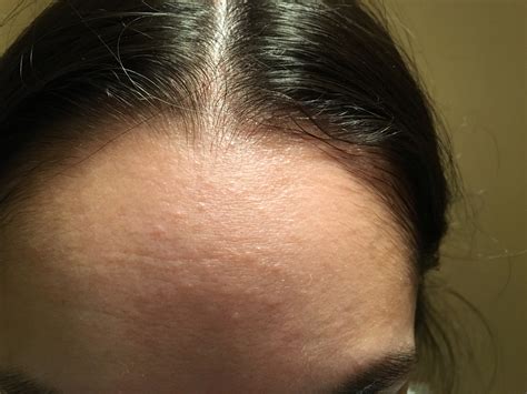 Small Red Bumps On Forehead Pictures Photos - Rezfoods - Resep Masakan Indonesia