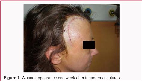 Figure 1 from Intradermal Sutures in Neurosurgery – Consecutive Series ...