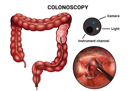 #1 Prep Instructions for Your Colonoscopy - Manhattan Gastroenterology