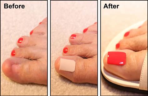 Acrylic Toe Nails, French Tip Acrylic Nails, Toenail Fungus Remedies, Toenail Fungus Treatment ...