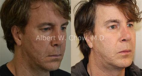 Acne Scar Treatment Before and After Photo Gallery | San Francisco, CA ...