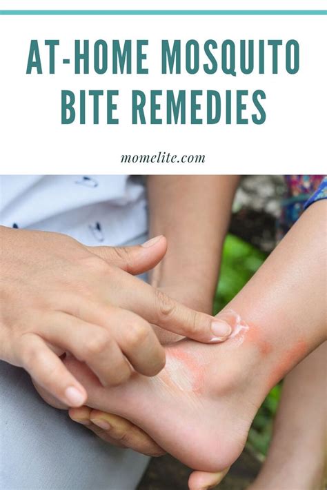 At-Home Mosquito Bite Remedies | Remedies for mosquito bites, Insect ...