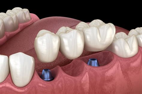 Dental Implant Supported Bridges » Dentist in Stoke-on-Trent ...