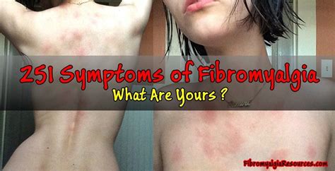 Pin on spoonie, fibro++