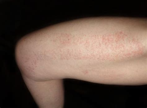 Red Spots on Skin: Causes, Diagnosis, and Treatments