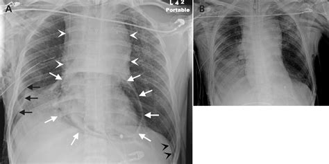 Pneumopericardium | CMAJ