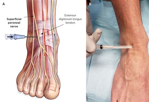 Superficial Peroneal Nerve Block