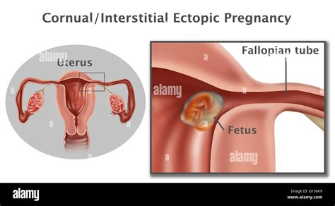 Illustration of a cornual/interstitial ectopic pregnancy. In an Stock ...