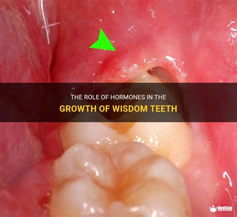 The Role Of Hormones In The Growth Of Wisdom Teeth | MedShun