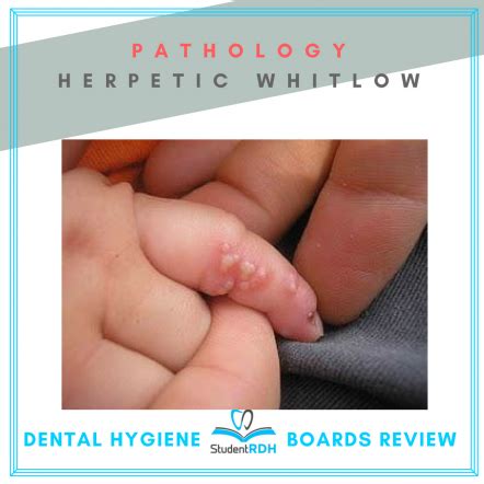 Q: A herpetic whitlow can occur if the: - StudentRDH Blog