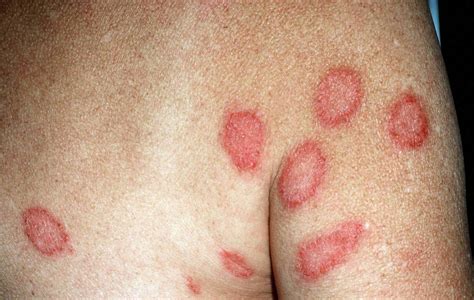Dermatitis - Contact, Atopic, Perioral, Nummular, Seborrheic, Stasis