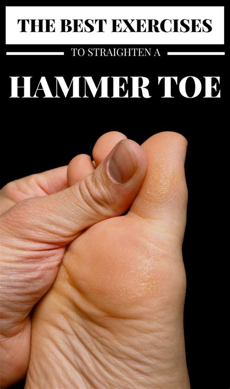 The Best Exercises To Straighten A Hammer Toe - FitnessStar.net ...