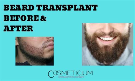Beard Transplant Before and After - Cosmeticium