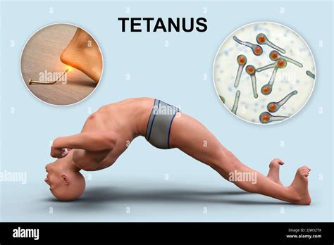 Mechanism of tetanus disease hi-res stock photography and images - Alamy