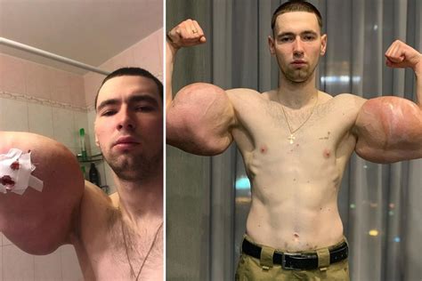 Russian bodybuilder with 24-inch oil-injected Popeye biceps has surgery to save arms after ...