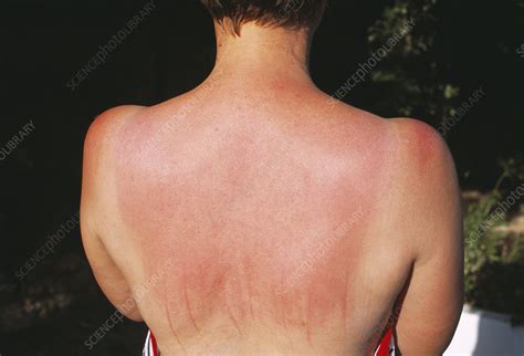 Sunburnt back - Stock Image - M335/0153 - Science Photo Library