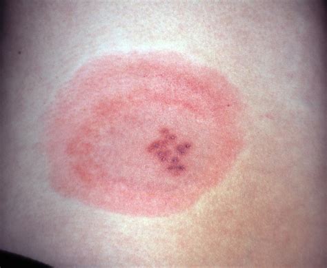 Shingles Rash On Inner Thigh