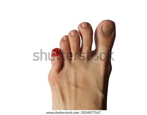 401 Swollen Thumb Images, Stock Photos, 3D objects, & Vectors | Shutterstock