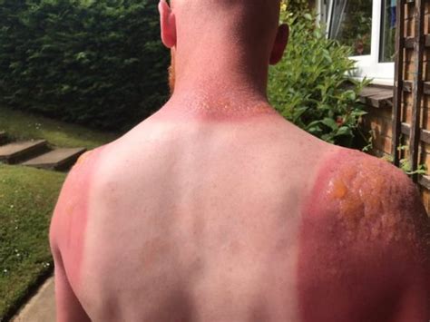 Sunburns - Symptoms, Causes And Associated Risk Factors