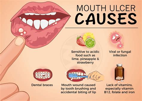 What is Mouth ulcers? - Leading Dental Clinic in Dubai - Best Dentist ...