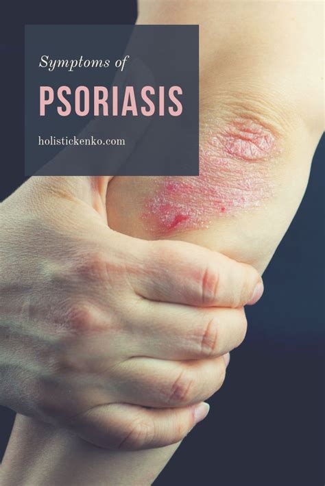 Psoriasis : Existing And Advances In Treatment Presentation