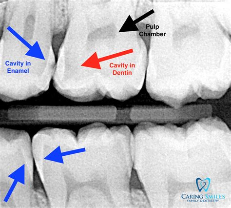 What is a Flossing Cavity and How Can I Prevent It? | Caring Smiles Family Dentistry, West ...