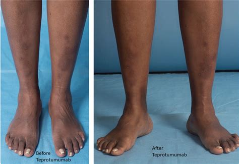 Showing pretibial myxedema before and after teprotumumab. | Download Scientific Diagram