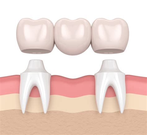 Are Dental Bridges Safe And Long Lasting?